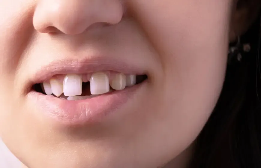 Zdjęcie Jak się nazywa przerwa między zębami i co warto o niej wiedzieć