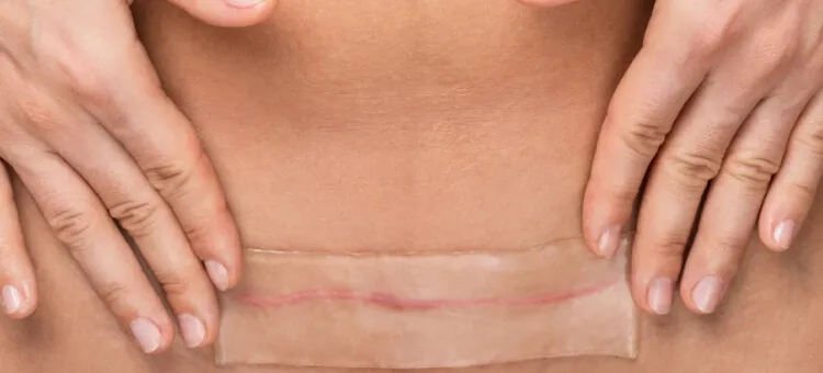 Zdjęcie Cesarskie cięcie na życzenie w Polsce - co warto wiedzieć przed decyzją?