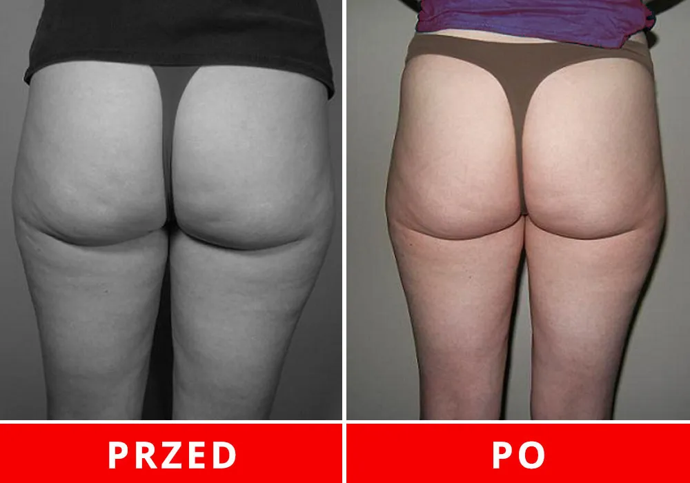 Zdjęcie Skuteczne sporty na cellulit, które naprawdę przynoszą efekty