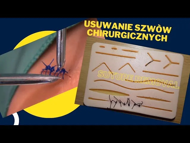 Zdjęcie Czy ściąganie szwów z dziąsła boli? Prawda o bólu i komfortcie