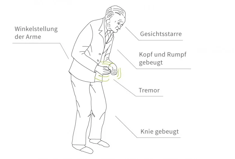 Zdjęcie Wichtige Schritte zur Parkinson Diagnostik: Symptome und Tests verstehen