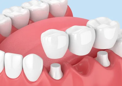 Zdjęcie Ile kosztuje mostek na 3 zęby? Sprawdź ceny i opcje leczenia