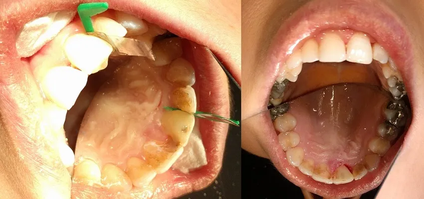 Zdjęcie Gdzie wyrwać zęba w Łodzi na NFZ - łatwe i bezpłatne opcje dentystyczne