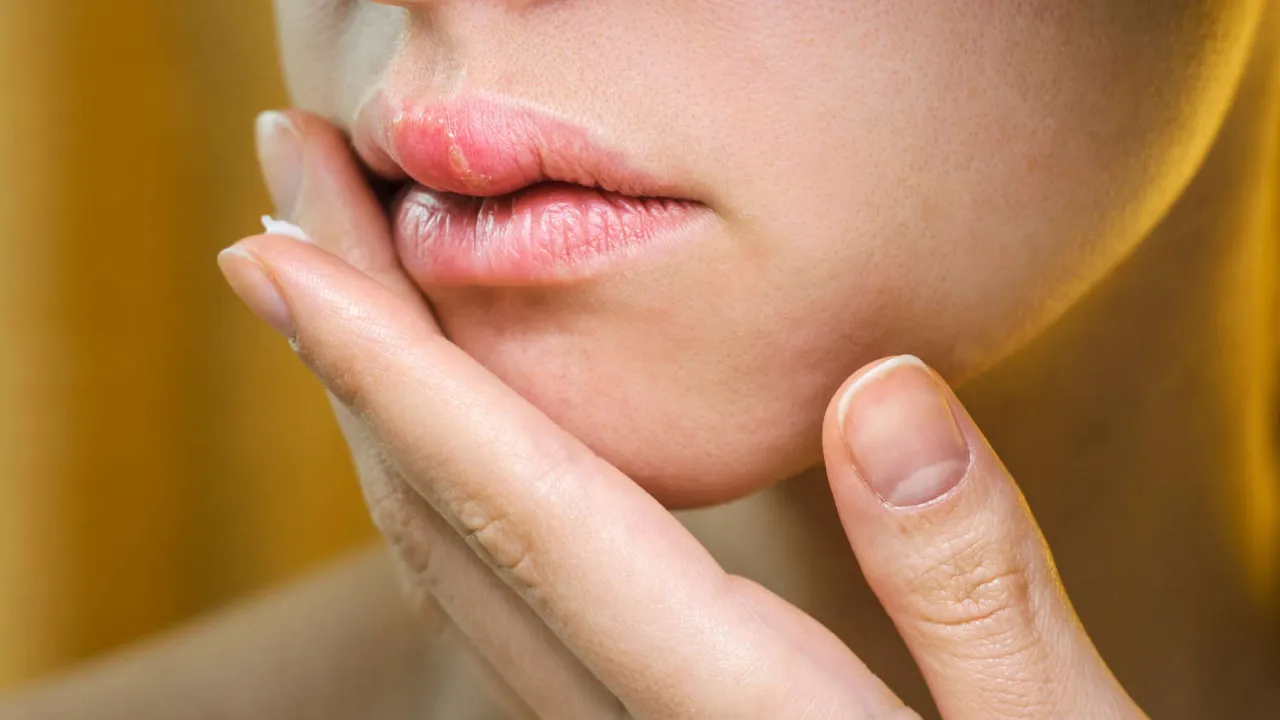 Zdjęcie Opryszczka a dentysta: Czy możesz iść? Kiedy przełożyć wizytę?