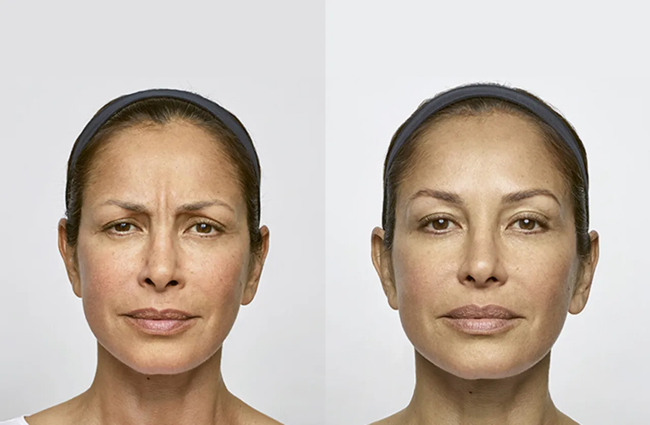 Zdjęcie Jak przeliczyć jednostki Azzalure na Botox dla skutecznych efektów