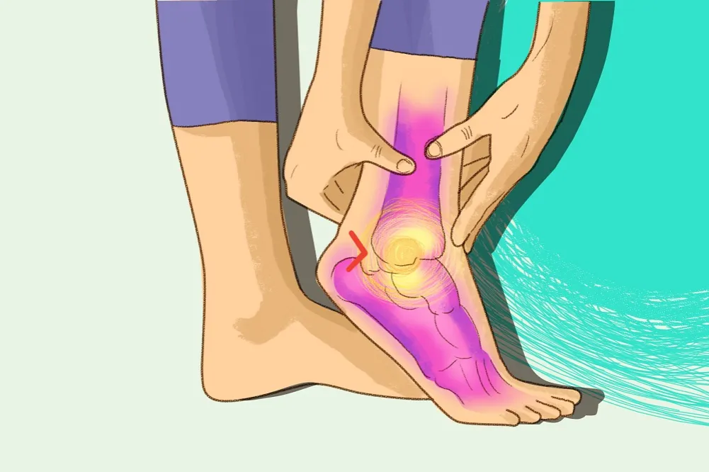 Zdjęcie Ostroga piętowa: do jakiego lekarza i jak leczyć?