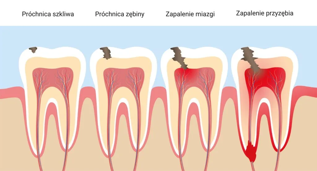 Zdjęcie Dlaczego bolą zęby? Odkryj przyczyny i skuteczne leczenie bólu