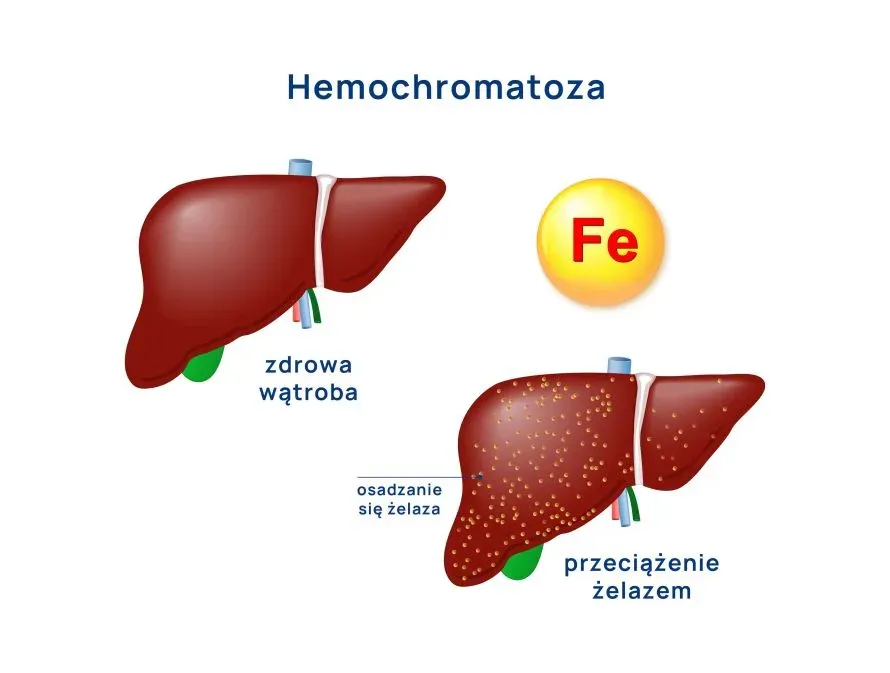 Zdjęcie Hemochromatoza: 5 objawów skórnych, które musisz znać