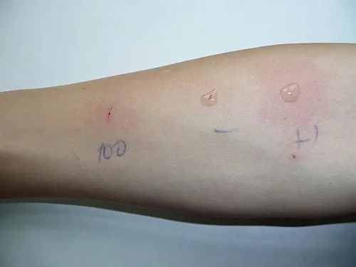 Zdjęcie Na ile przed testami alergicznymi odstawić leki, aby uzyskać dokładne wyniki?