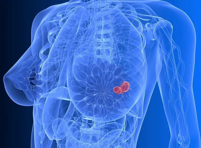 Zdjęcie Czy rak piersi boli? Odpowiadamy na najważniejsze pytania i objawy.