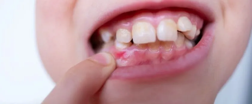 Zdjęcie Od czego puchną dziąsła? Poznaj przyczyny i jak ich unikać