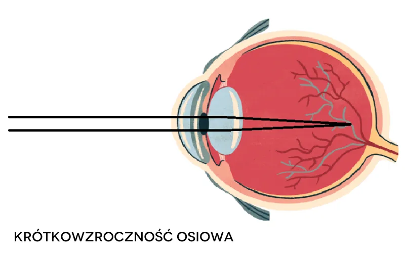 Zdjęcie Jaka wada wzroku może się cofnąć? Zaskakujące fakty o korekcji wzroku.