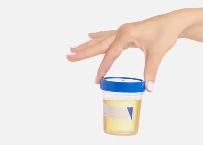 Zdjęcie Jak pobrać mocz na posiew, aby uniknąć błędów i uzyskać dokładne wyniki