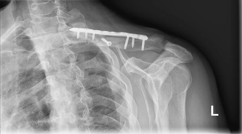Zdjęcie Ile trwa rehabilitacja po złamaniu obojczyka? Kluczowe informacje o czasie regeneracji