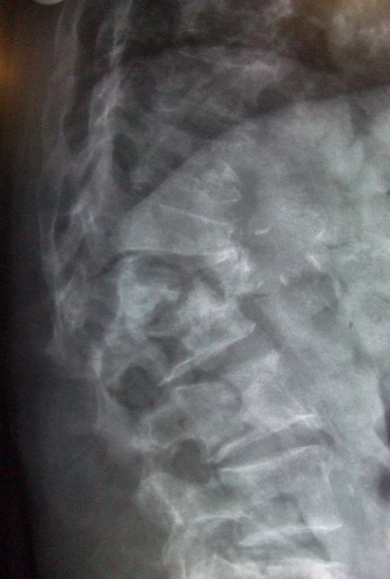 Zdjęcie Quién descubrió la osteoporosis y su impacto en la salud ósea