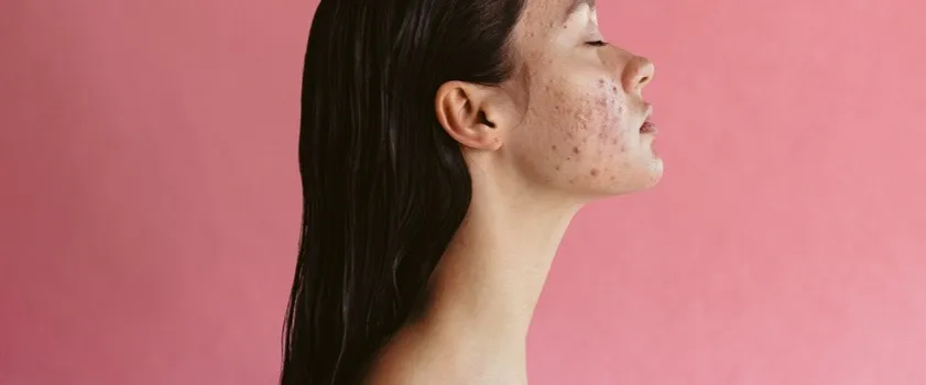 Zdjęcie Czerwone ślady po pryszczach: Skuteczne sposoby na PIE