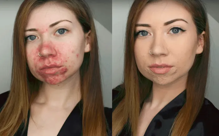 Zdjęcie Jak ukryć pryszcze makijażem i uzyskać naturalny efekt bez wysiłku