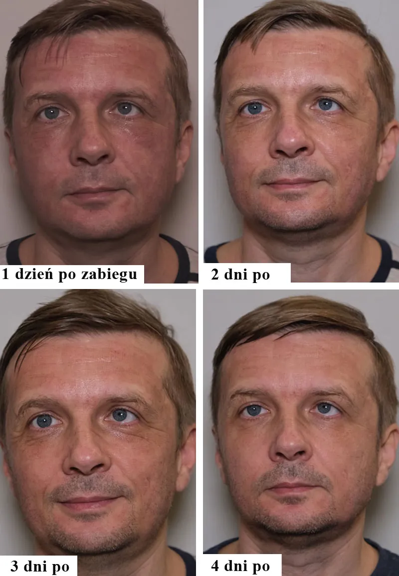 Zdjęcie Jak wygląda twarz po zabiegu laserem frakcyjnym? Zaskakujące efekty!
