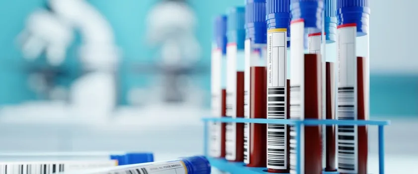 Zdjęcie Prawidłowy cholesterol LDL: jakie wartości są niebezpieczne dla zdrowia?