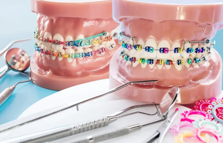 Zdjęcie Ile kosztuje aparat na zęby góra i dół? Sprawdź ceny i opcje!