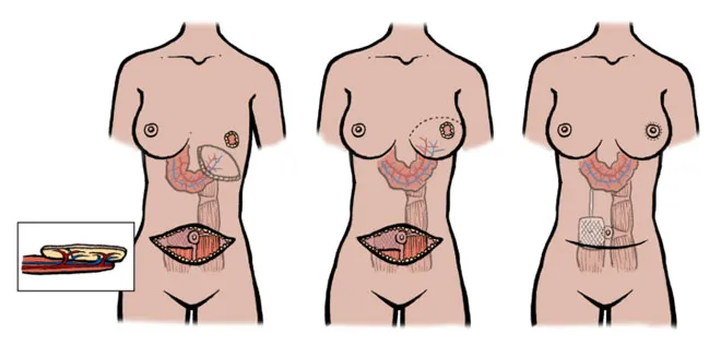 Zdjęcie Wygląd piersi po rekonstrukcji: Zobacz efekty i zdjęcia przed i po zabiegu