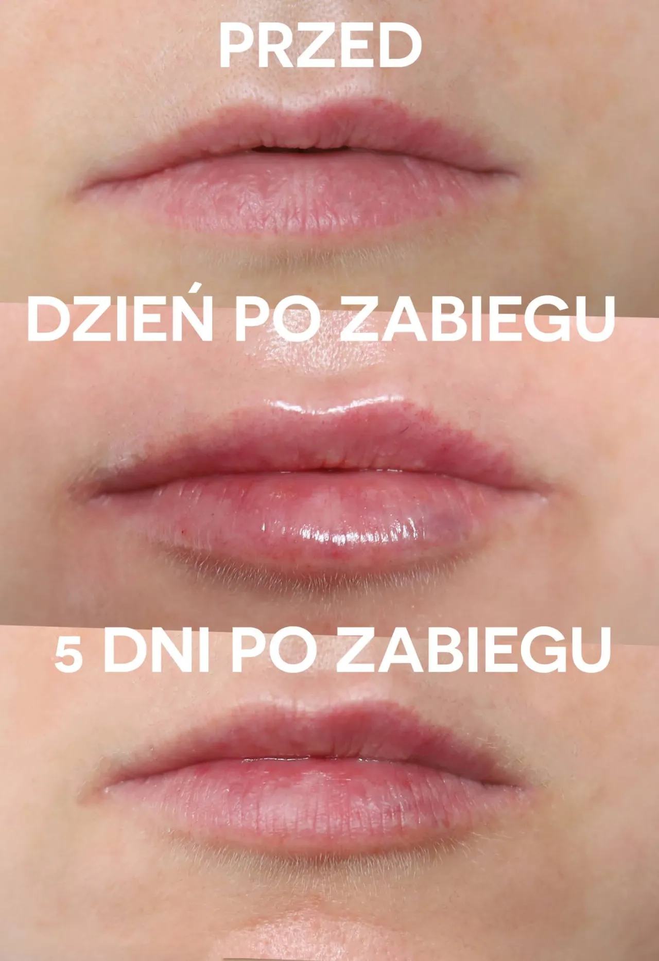 Zdjęcie Ile kwasu hialuronowego w usta to bezpieczna dawka? Porady i przeciwwskazania