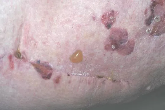 Zdjęcie Morbus Duhring Diagnostik: Wichtige Tests und Verfahren zur sicheren Diagnose