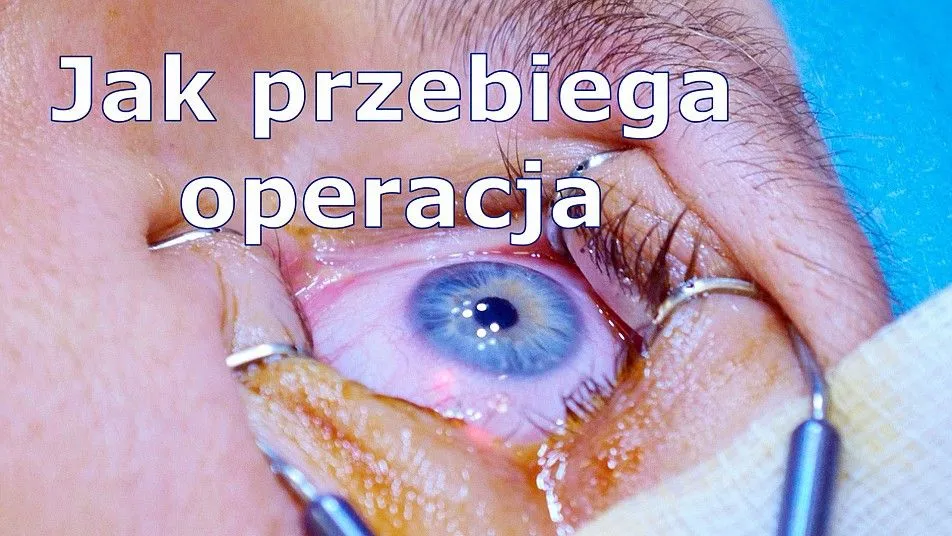 Zdjęcie Jak działa laserowa korekcja wzroku i co warto o niej wiedzieć