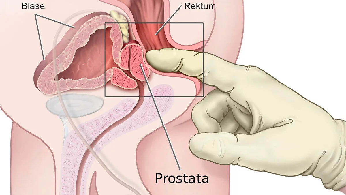 Zdjęcie Wichtige Informationen zur Vorsorge Prostatakrebs: Tests und Empfehlungen