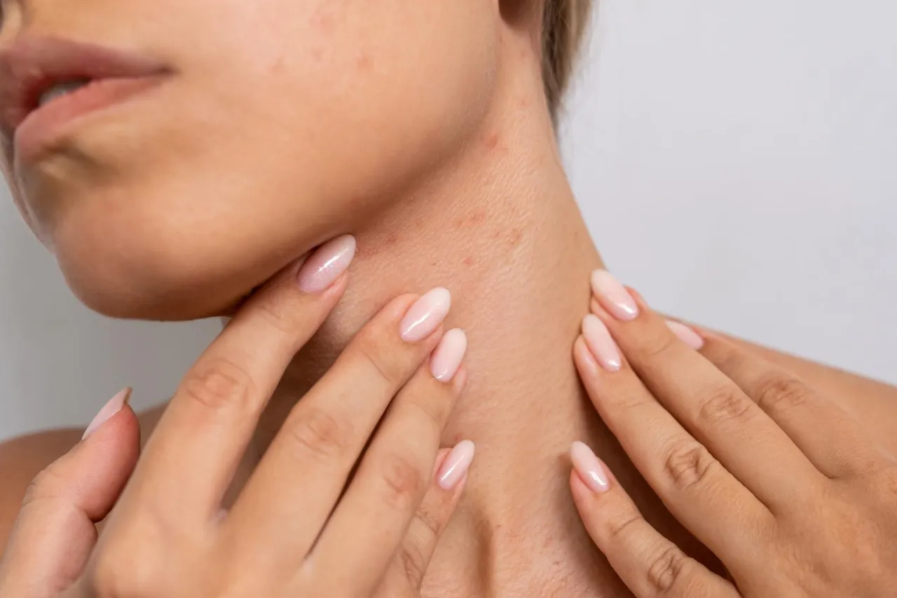 Zdjęcie Pryszcze na szyi od czego? Odkryj przyczyny i skuteczne rozwiązania