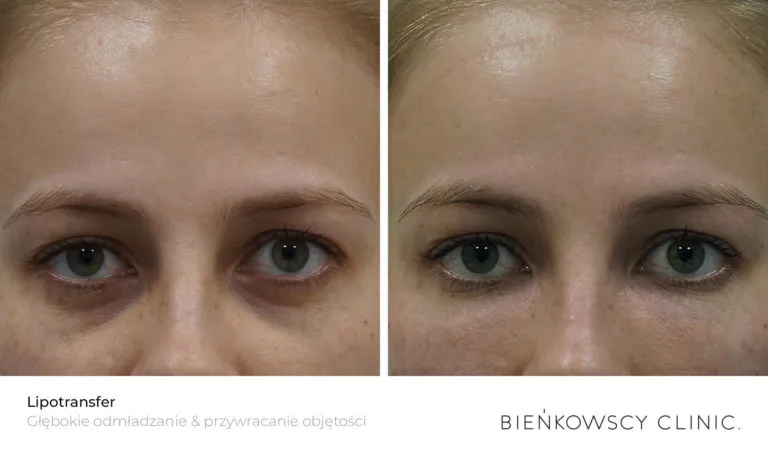 Zdjęcie Lipotransfer biustu: ile się utrzymuje i jak przedłużyć efekty?