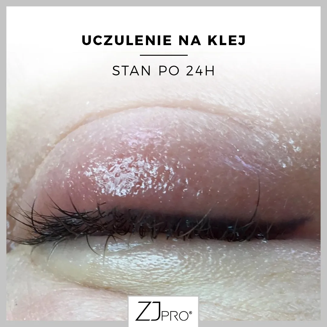 Zdjęcie Jak skutecznie zwalczyć uczulenie na klej do rzęs i uniknąć nieprzyjemnych objawów