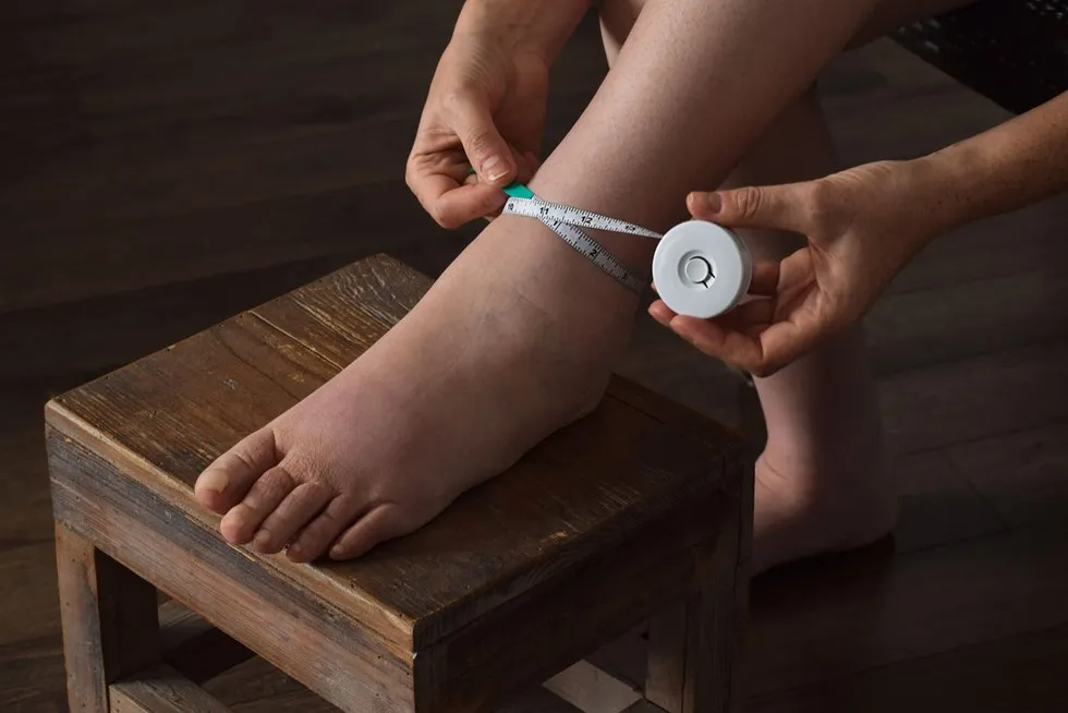 Zdjęcie Obrzęk limfatyczny n&oacute;g? Skuteczne ćwiczenia, kt&oacute;re przyniosą ulgę!