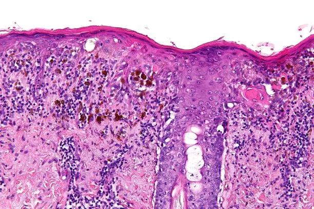 Zdjęcie Czy zdarzają się pomyłki w badaniach histopatologicznych? Oto prawda