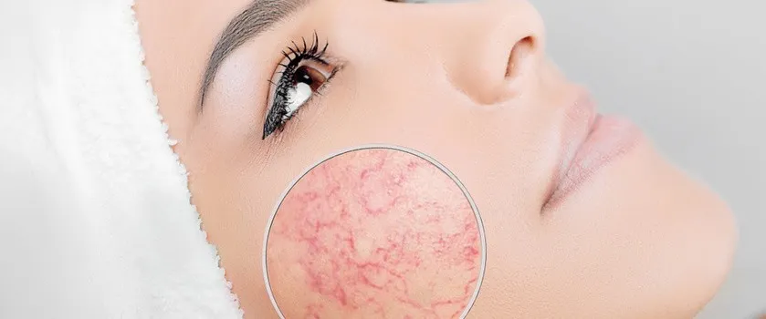 Zdjęcie Cera naczynkowa: Jak rozpoznać i pielęgnować? Objawy, przyczyny