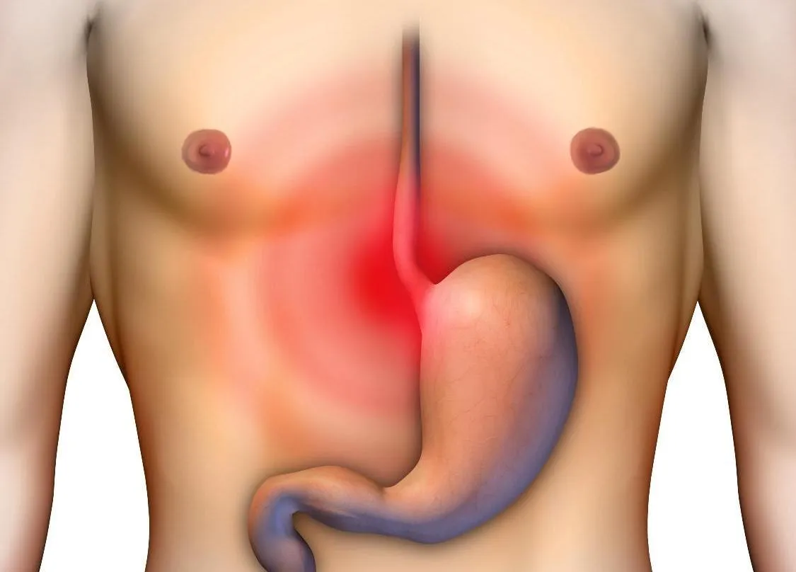 Zdjęcie ICD-10: Przepuklina rozworu przełykowego – co warto wiedzieć?