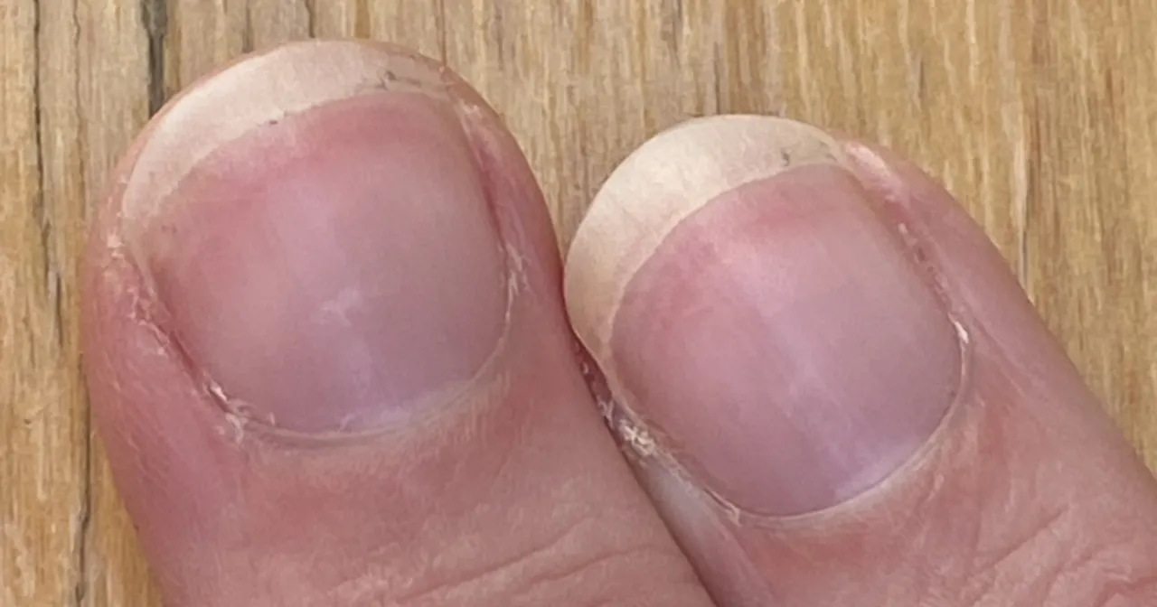 Zdjęcie Paski na paznokciach co oznaczają – objawy, które mogą zaskoczyć