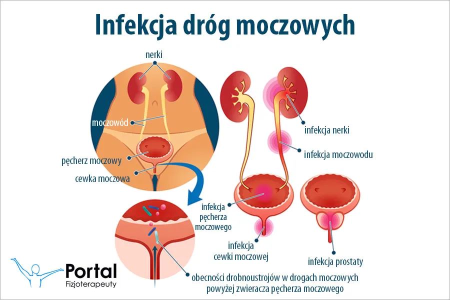 Zdjęcie Zapalenie pęcherza i pochwy – metody leczenia i porady.