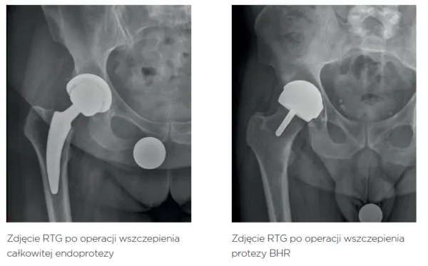Zdjęcie Jakie endoprotezy stawu biodrowego refunduje NFZ i co warto wiedzieć