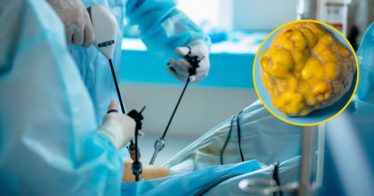 Zdjęcie Bezpieczny powr&oacute;t do ćwiczeń po usunięciu woreczka ż&oacute;łciowego