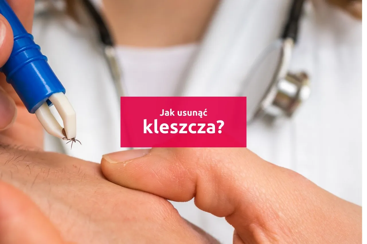 Zdjęcie Jak wyjąć kleszcza u człowieka - bezpieczne metody i porady