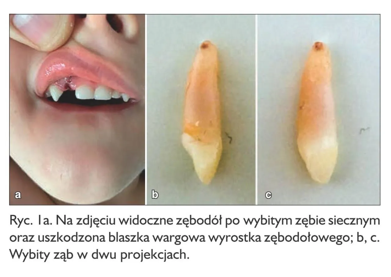 Zdjęcie Jak wygląda korzeń zęba mlecznego? Odkryj jego tajemnice i znaczenie