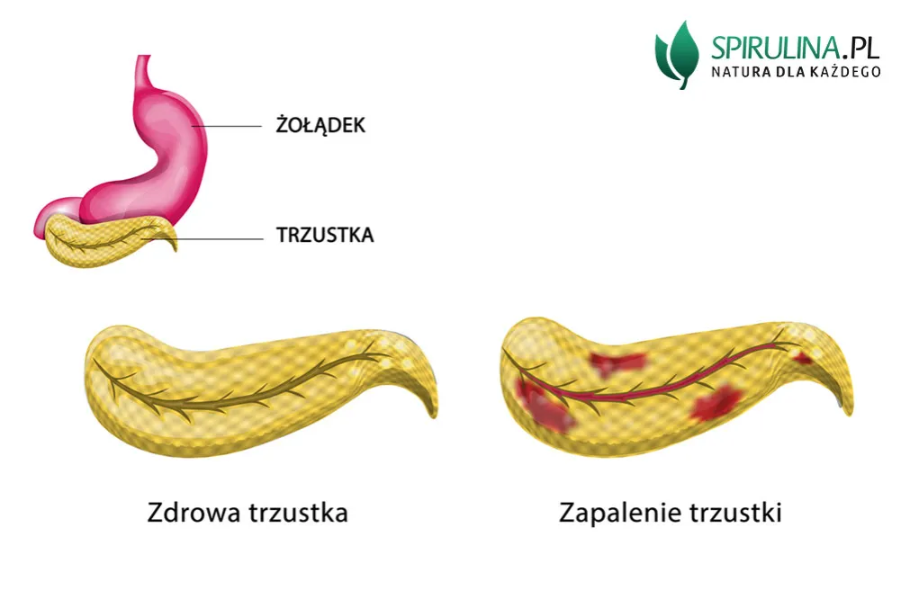 Zdjęcie Alkoholowe zapalenie trzustki: objawy, które mogą Cię zaskoczyć