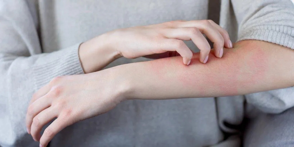Zdjęcie Nietolerancja fruktozy objawy skórne - rzadkie symptomy, które zaskakują