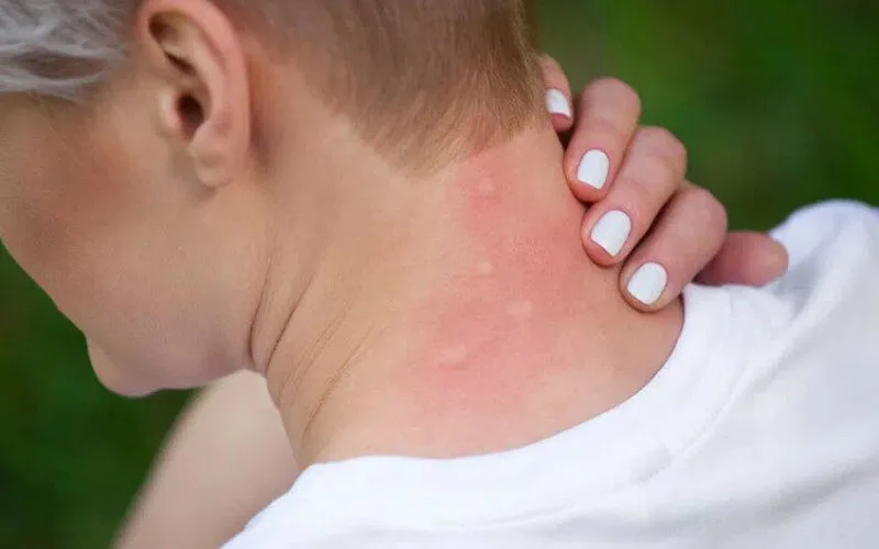 Zdjęcie Uczulenie na ogórki kiszone objawy – jak je rozpoznać i unikać
