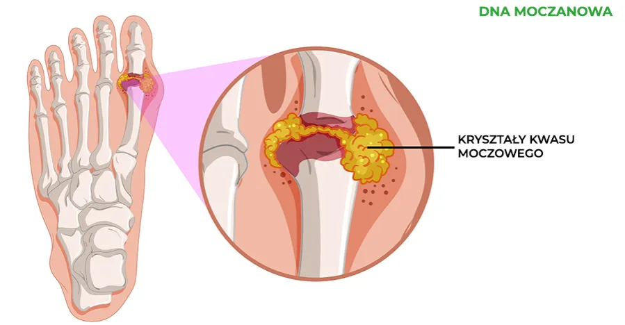 Zdjęcie Podwyższony poziom kwasu moczowego: przyczyny, objawy i leczenie