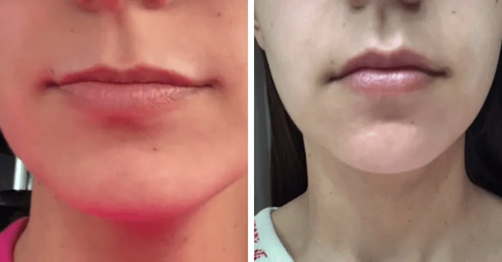 Zdjęcie Jak długo utrzymuje się botoks na usta? Poznaj zaskakujące fakty