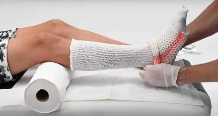 Zdjęcie Pieczenie pod gipsem jest normalne? Sprawdź, co to oznacza dla Ciebie