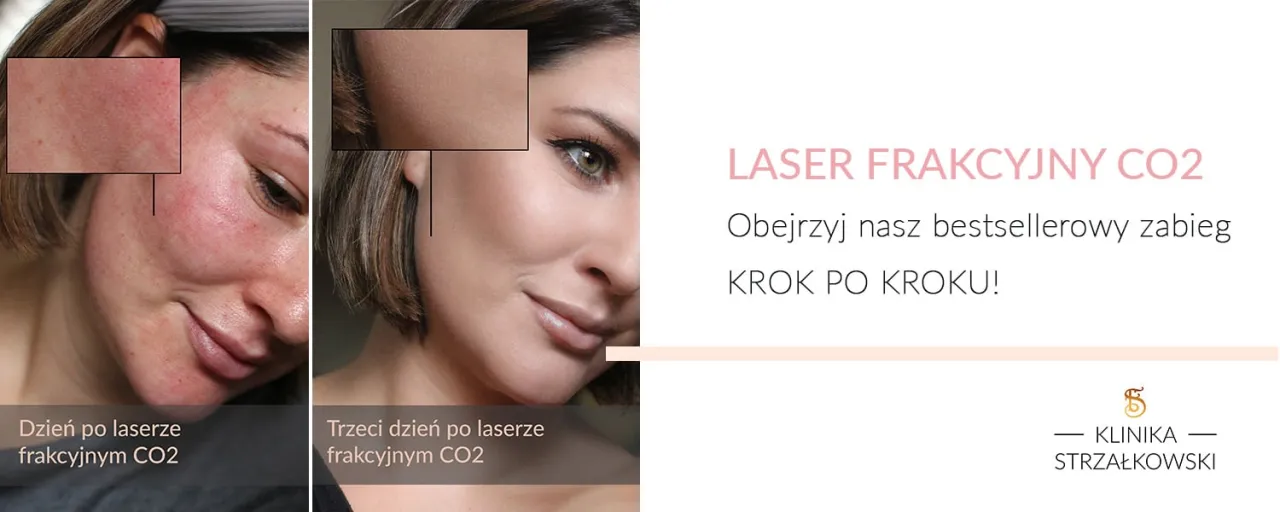 Zdjęcie Laser frakcyjny CO2 – co to jest i jak może odmłodzić Twoją skórę