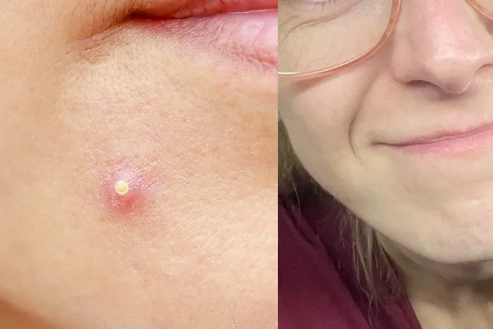 Zdjęcie Czy pryszcz sam zniknie? Oto prawda o naturalnym gojeniu